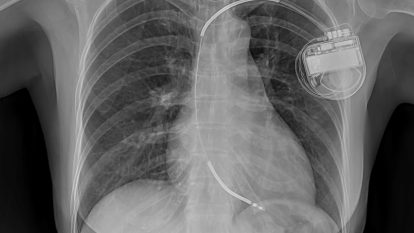 Zoom-in of the Chest x-ray image a human  on of permanent pacemaker implant in body chest. Medical technology concept.
 Royalty-Free Stock Footage #1094439325