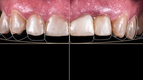 digital planning for full smile case - Powered by Shutterstock - Get 15% off with code: PIKWIZARD15