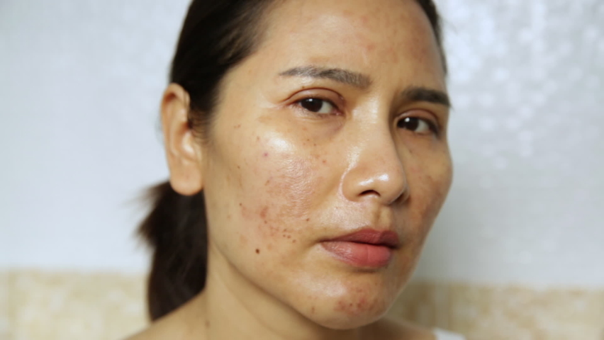 Close up of  women having skin problems on white background. Women having damage skin burn after laser on her face Royalty-Free Stock Footage #1095348705
