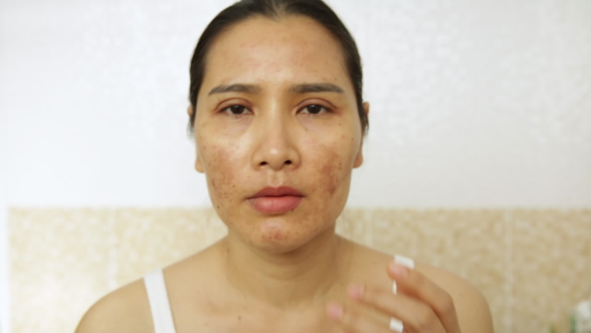 Close up of  women having skin problems on white background. Women having damage skin burn after laser on her face Royalty-Free Stock Footage #1095348709