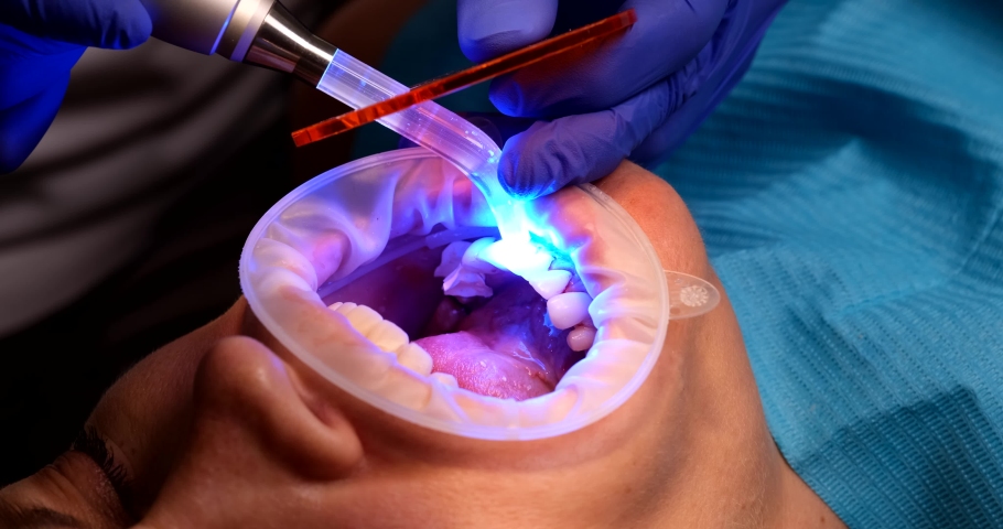 Closeup of female patient installing dental veneers and ultraviolet lamp at dentist in clinic | Shutterstock HD Video #1095355993