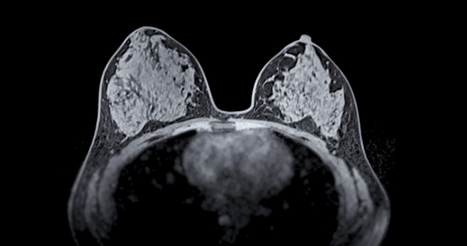 Breast MRI magnetic resonance imaging of the breast uses radio waves and strong magnets to make detailed pictures of the inside of the breast To screen for breast cancer. | Shutterstock HD Video #1095579395