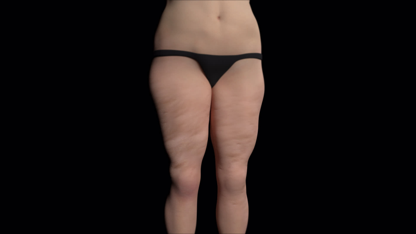 This 3d animation shows the imperfection of cellulite on female thighs