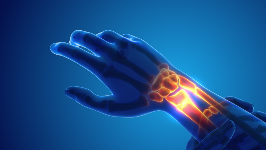 Broken Wrist bone pain medical concept Royalty-Free Stock Footage #1096375311
