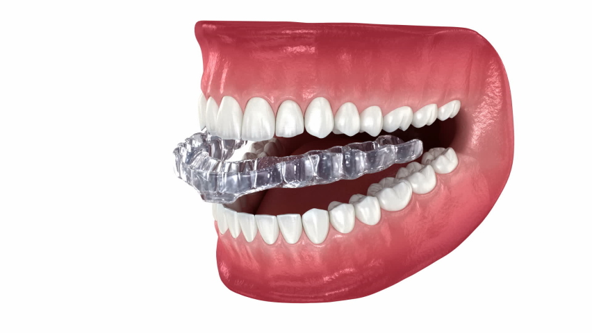 Bite Splint - bite correction. Medically accurate dental 3D illustration