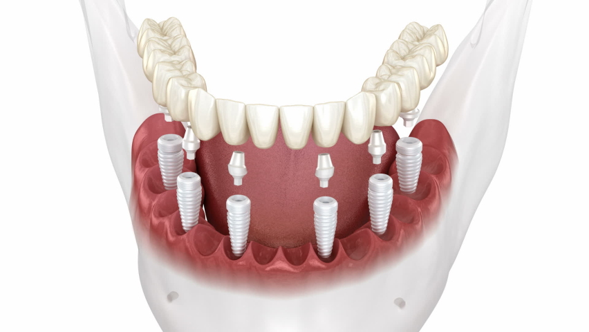 Dental prosthesis based on 6 ceramic implants. Dental 3D animation Royalty-Free Stock Footage #1096602321