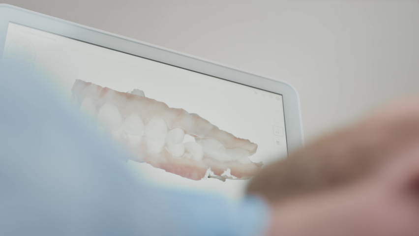 A male orthodontist doctor shows on the display a 3d model of the oral cavity of a man patient. Medical examination of teeth. Digital scanning with a scanner, checking the jaw. Dental clinic office. Royalty-Free Stock Footage #1096755263