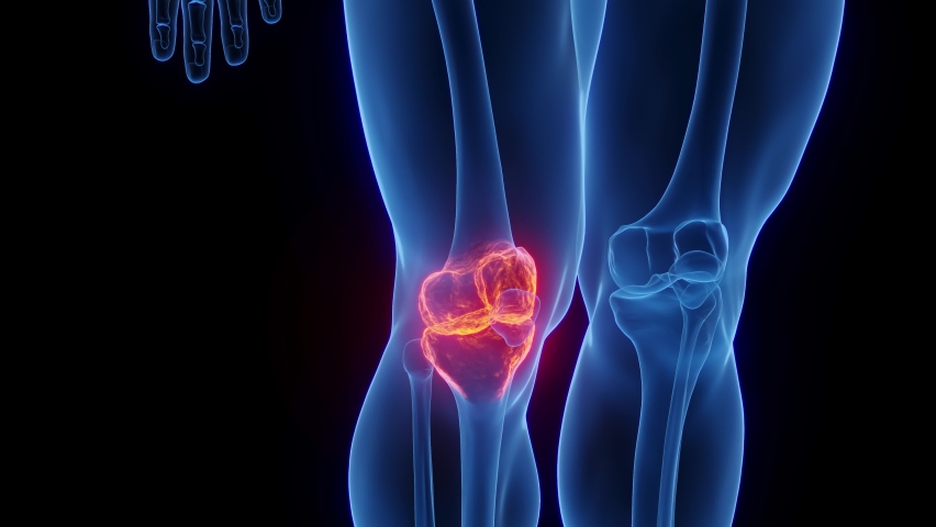 3D rendered Medical Animation of Male Anatomy - Inflamed Knee Healing. Plain Black Background. Professional Studio Lighting. Royalty-Free Stock Footage #1097104825