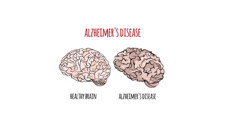 ALZHEIMER VIDEO Disease Memory Loss Brain Damage Medicine Health Treatment Therapy Video Banner Animated Poster Scheme Of The Structure Of A Human Disease | Shutterstock HD Video #1097196141