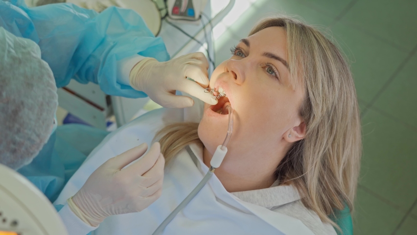 Dentist at work. hands of a dentist doing something in the patient's mouth | Shutterstock HD Video #1097198063