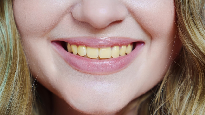 Close-up. a woman's smile in the process of whitening teath. the concept of professional cleaning and whitening of teeth or ceramic veneers. processing of teeth in the photo editor. | Shutterstock HD Video #1097241153