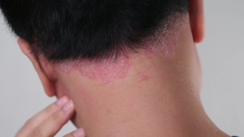 a man showing his Psoriasis on his nape. Royalty-Free Stock Footage #1097381179