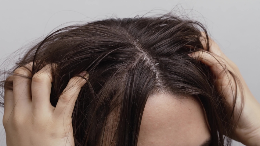 Woman scratching her head with dandruff | Shutterstock HD Video #1097431301