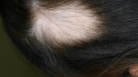 Woman hair loss. Doctor or cosmetologist does inspection, makes procedures, head of woman skin of which there is no hair. Alopecia areata, lichen, trichopetia, microsporia.