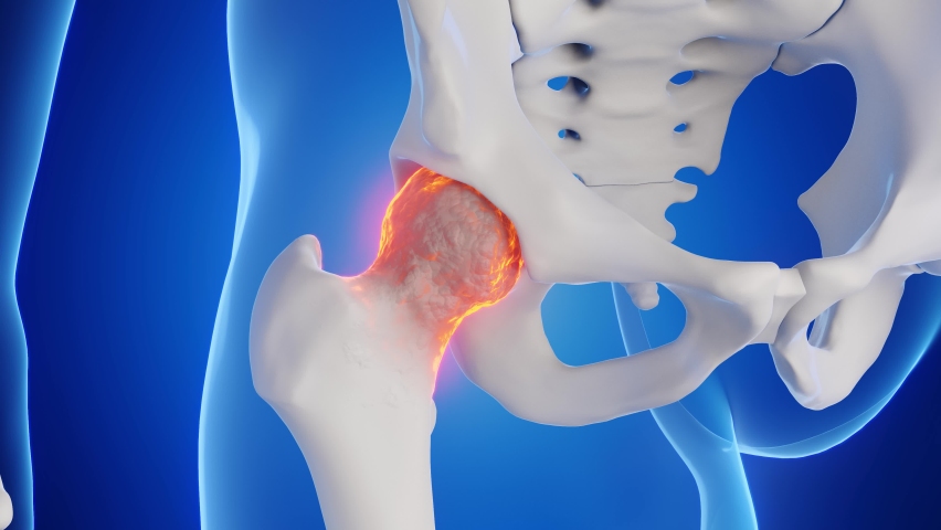 3d rendered medical animation of a man's hip joint. blue background. anterior view Royalty-Free Stock Footage #1097459019