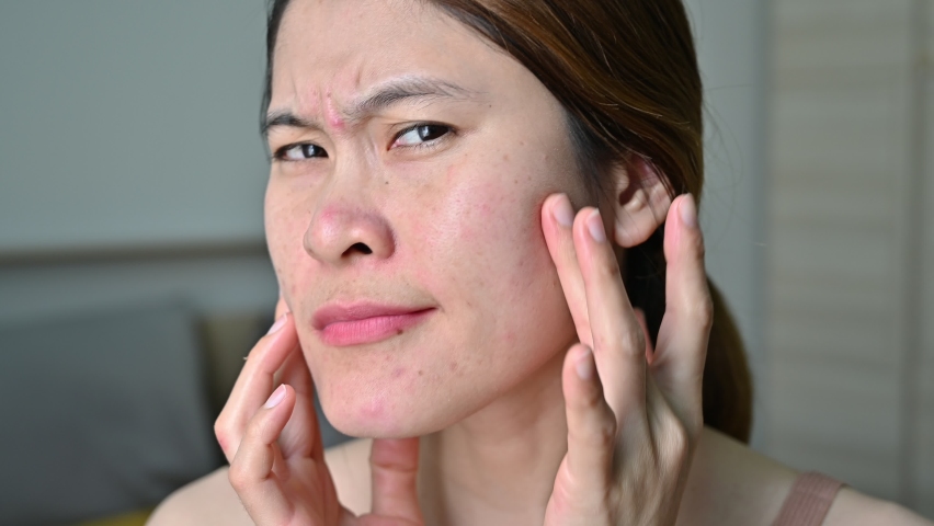 Asian woman worried about her face when she saw acne and wrinkled occur on her face. Conceptual shot of Acne and Problem Skin on female face. Royalty-Free Stock Footage #1097567437