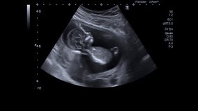 The video that focuses on the baby's movements while in the womb.