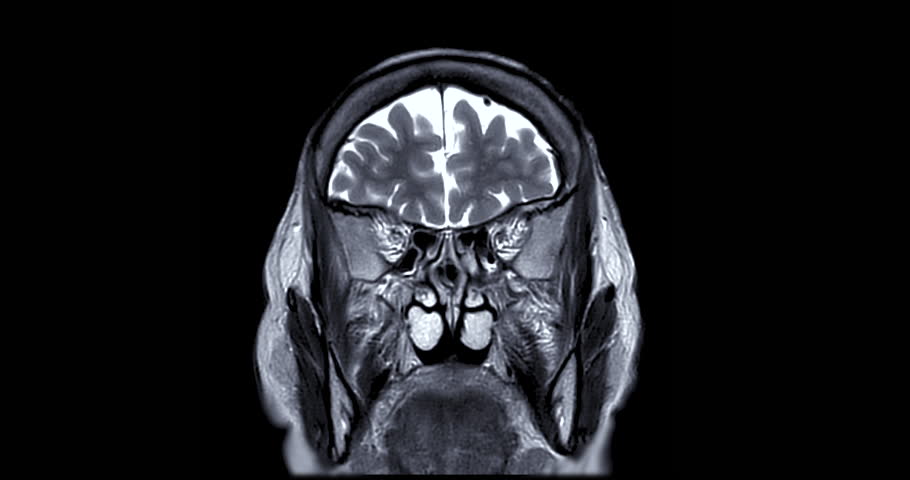 MRI Brain Coronal T2w oblique can help doctors look for conditions dementia. Royalty-Free Stock Footage #1098635407