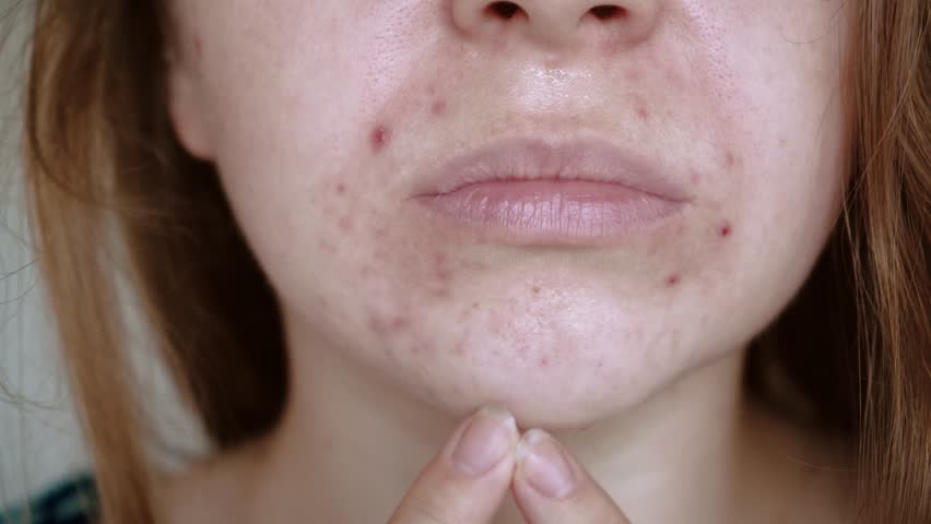 Close up of skin problems, unhealthy skin with acne and pimples. Porous, demodex and rosacea, red rashes. The concept of care for problem skin. Allergic and redness. | Shutterstock HD Video #1098823301