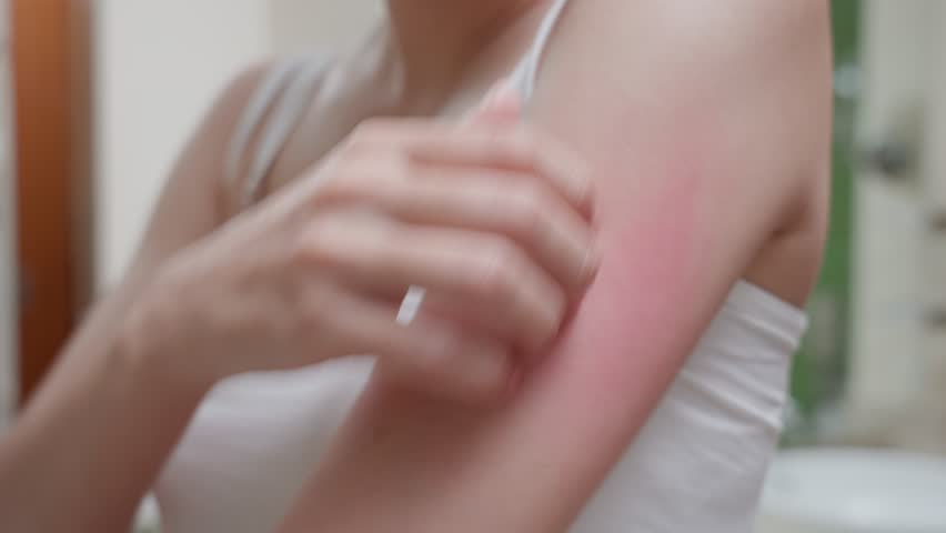 Skin problem and beauty. Young woman scratch body has itchy skin from skin allergic, steroid allergy, sensitive skin, red from sunburn, chemical allergy, rash, insect bites, Seborrheic Dermatitis. | Shutterstock HD Video #1098839125
