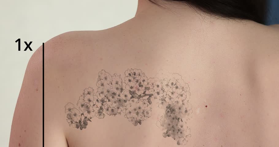Laser Tattoo Removal On Woman's Shoulder. Medical Treatment Royalty-Free Stock Footage #1098839617