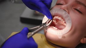 Close-up of a real procedure for extracting a molar baby tooth that interferes with the growth of permanent teeth, in a child with a retractor in his mouth. Medical content for pediatric dentistry