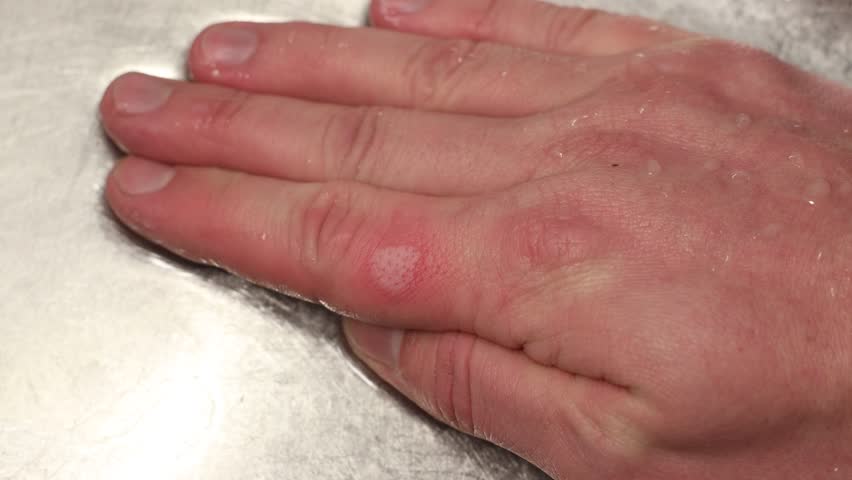 Burned skin on a finger. The Caucasian man keeps his hand under the cold running water - red burned skin patch Royalty-Free Stock Footage #1099309011