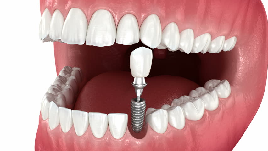 Dental implant and ceramic crown placement. Medically accurate tooth 3d animation | Shutterstock HD Video #1099507957