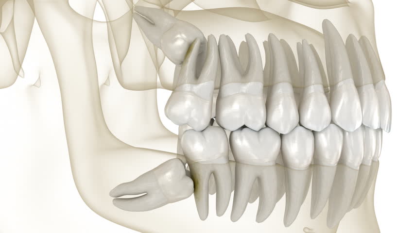 Mesial impaction of Wisdom teeth to the second molar. Medically accurate tooth 3d animation