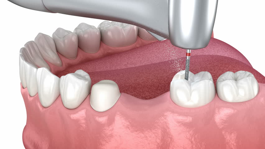 Dental bridge placement. Medically accurate 3D animation | Shutterstock HD Video #1099507963