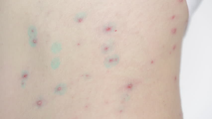 Body of adult  man have spotted, red pimple and bubble rash from monkeypox or varicella zoster virus | Shutterstock HD Video #1099530499