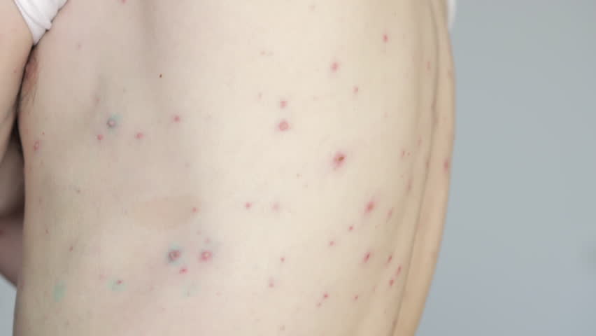 Body of adult  man have spotted, red pimple and bubble rash from chickenpox or varicella zoster virus | Shutterstock HD Video #1099530501