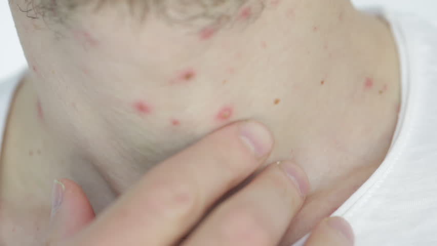 Body of adult  man have spotted, red pimple and bubble rash from monkeypox or varicella zoster virus. Medical complications after illness | Shutterstock HD Video #1099530503