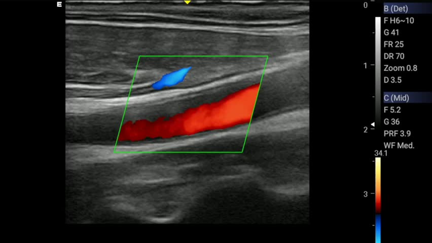 Color Doppler Ultrasound Carotid Artery Royalty-Free Stock Footage #1099599769