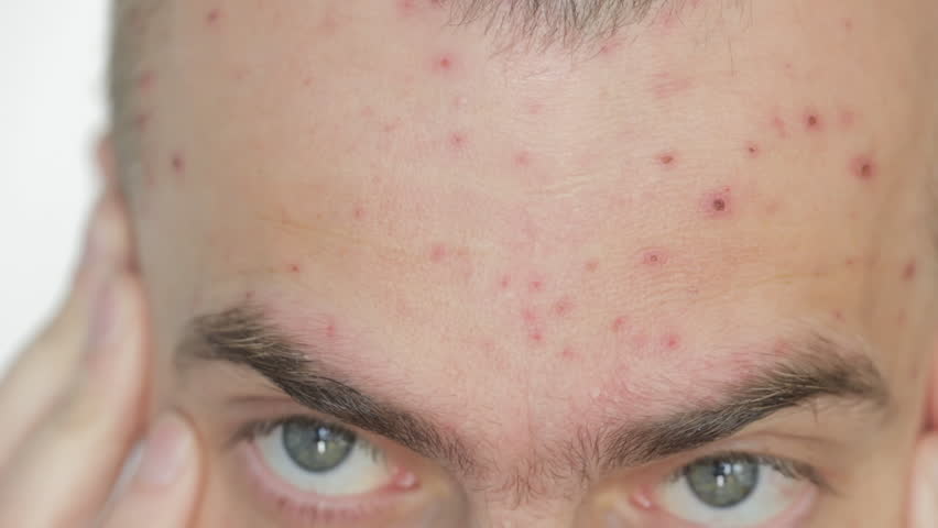 Body of adult  man have spotted, red pimple and bubble rash from monkeypox or varicella zoster virus. Medical complications after illness | Shutterstock HD Video #1099645959