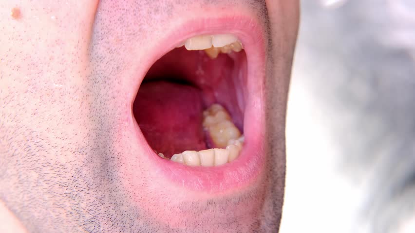 Closeup doctor conducts an examination of oral cavity of young male patient, tries on Silicone Night Mouth Guard for Teeth Clenching Grinding Dental Bite Sleep Aid, concept of dental services | Shutterstock HD Video #1099683889