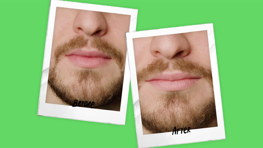 Collage of two side pictures, on a green background, before and after, with black writing, with a man's teeth. Teeth whitening treatment. Man smiling broadly after teeth whitening procedure. | Shutterstock HD Video #1099684903