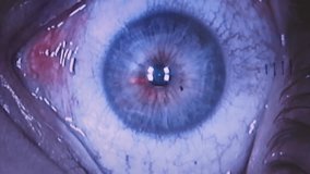Laser vision correction. Video recording of the operation from the surgeon's monitor