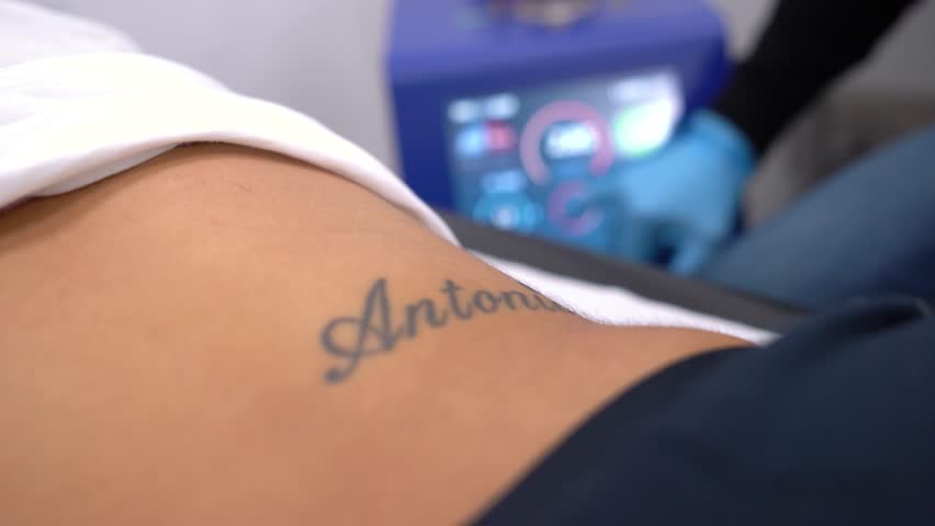 Girl erasing tattoo of exboyfriend name, deleting or removing. Dermatologist clinic tatto erase professionaly. Royalty-Free Stock Footage #1099715873