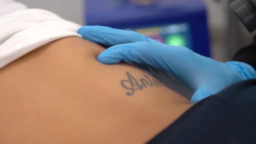 Girl erasing tattoo of exboyfriend name, deleting or removing. Dermatologist clinic tatto erase professionaly. Royalty-Free Stock Footage #1099715875