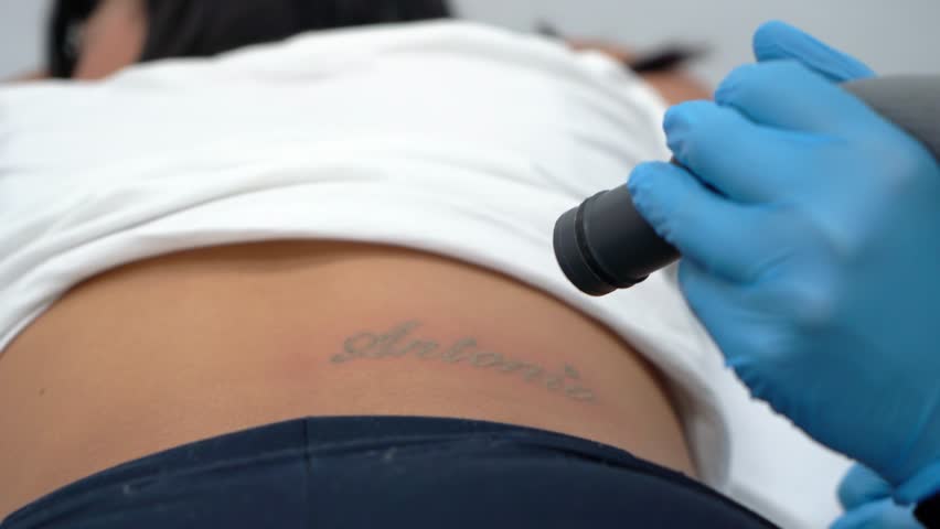 Girl erasing tattoo of exboyfriend name, deleting or removing. Dermatologist clinic tatto erase professionaly. Royalty-Free Stock Footage #1099715883