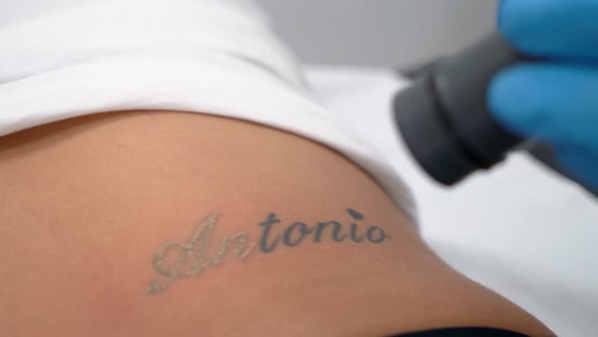 Girl erasing tattoo of exboyfriend name, deleting or removing. Dermatologist clinic tatto erase professionaly. Royalty-Free Stock Footage #1099715887