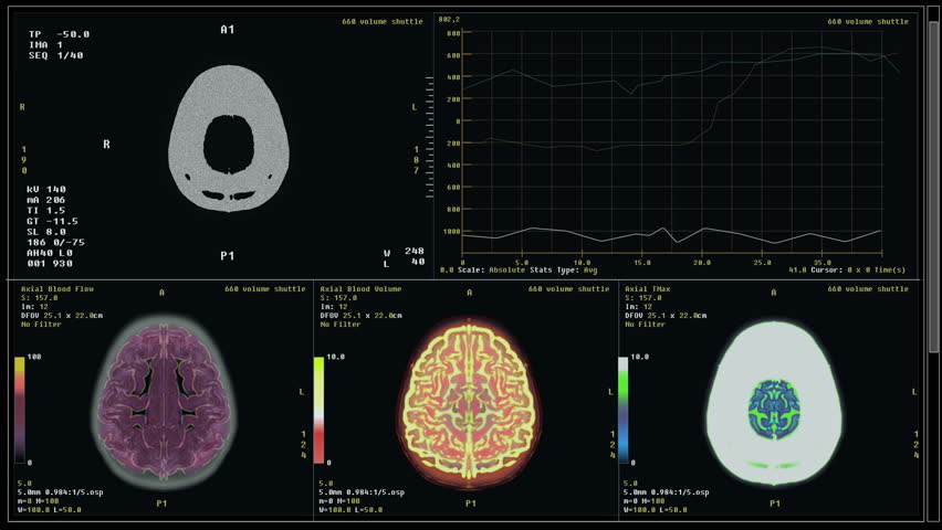 Patient Brain Scanned By Medical Equipment For Cancer Disease Diagnosis. Patient Head Analysis. Medical Diagnosis Examination. Checking Patient Brain Injury. Medical Equipment For Disease Diagnosis Royalty-Free Stock Footage #1099752181