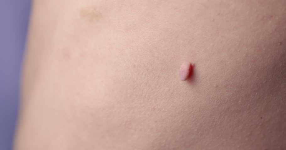 Close-up of Neoplasm or Birthmark on the Skin of an adult male. Pigmented spots on the back of a man. Skin with moles and Acne. | Shutterstock HD Video #1099834981