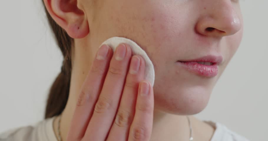 Cropped view of the teen girl with problem skin applying treatment cream on white background. Skin care concept  | Shutterstock HD Video #1099919609