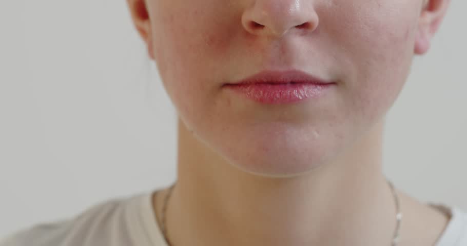 Cropped shot of young woman's face touching acne on face. Pimples, red scars on the cheeks and chin of a girl. Problem skin, health care and beauty concept. Dermatology, cosmetology  | Shutterstock HD Video #1099919621