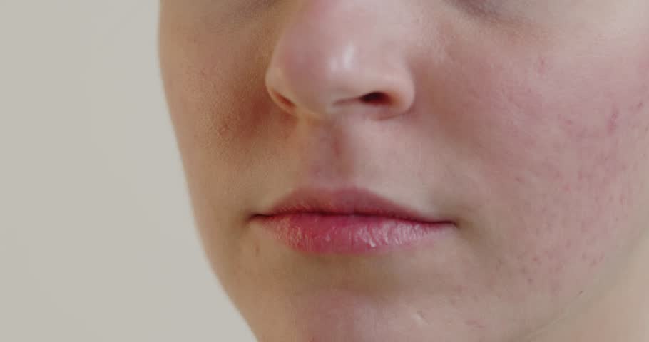 Close up view of woman acne skin caused by hormone. Red rash on young woman face, Itchy and allergic skin problems, dermatitis  | Shutterstock HD Video #1099919633