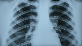 X-RAY ASSESSMENT OF THE LUNGS NORM AND PATHOLOGY. In the image of the chest of lung abnormalities, areas of high or low density are manifested. Close up - Powered by Shutterstock - Get 15% off with code: PIKWIZARD15