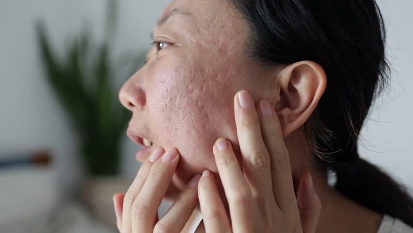 Close up of sad Asian woman touching acne on her face. | Shutterstock HD Video #1100031015