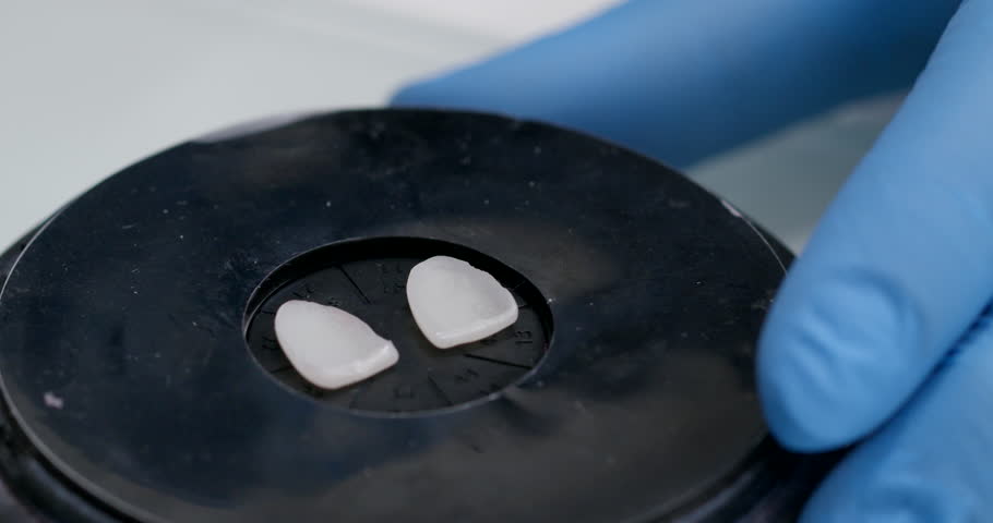 Close-up, ceramic onlays for the teeth of a patient of a dental clinic on a plastic table, ceramic blanks for the front teeth. Minimally invasive porcelain veneers | Shutterstock HD Video #1100260271